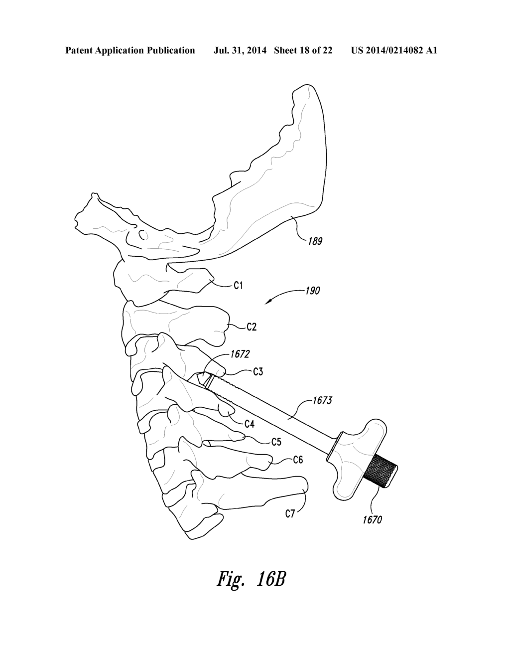 SPINAL SPACER FOR CERVICAL AND OTHER VERTEBRA, AND ASSOCIATED SYSTEMS AND     METHODS - diagram, schematic, and image 19