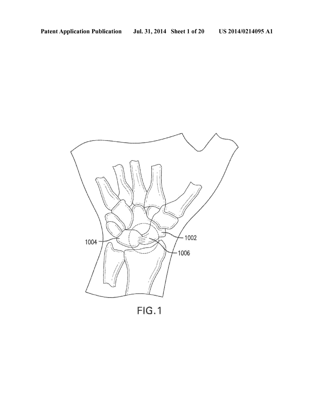 SYSTEMS AND DEVICES FOR THE REDUCTION AND ASSOCIATION OF BONES - diagram, schematic, and image 02