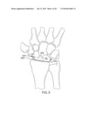 SYSTEMS AND DEVICES FOR THE REDUCTION AND ASSOCIATION OF BONES diagram and image