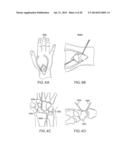 SYSTEMS AND DEVICES FOR THE REDUCTION AND ASSOCIATION OF BONES diagram and image