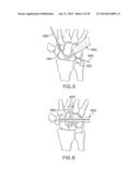 SYSTEMS AND DEVICES FOR THE REDUCTION AND ASSOCIATION OF BONES diagram and image