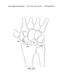 SYSTEMS AND DEVICES FOR THE REDUCTION AND ASSOCIATION OF BONES diagram and image