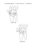 SYSTEMS AND DEVICES FOR THE REDUCTION AND ASSOCIATION OF BONES diagram and image