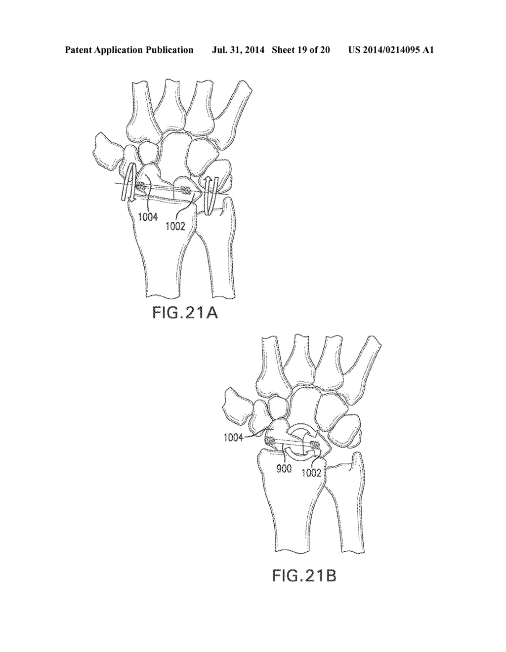 SYSTEMS AND DEVICES FOR THE REDUCTION AND ASSOCIATION OF BONES - diagram, schematic, and image 20