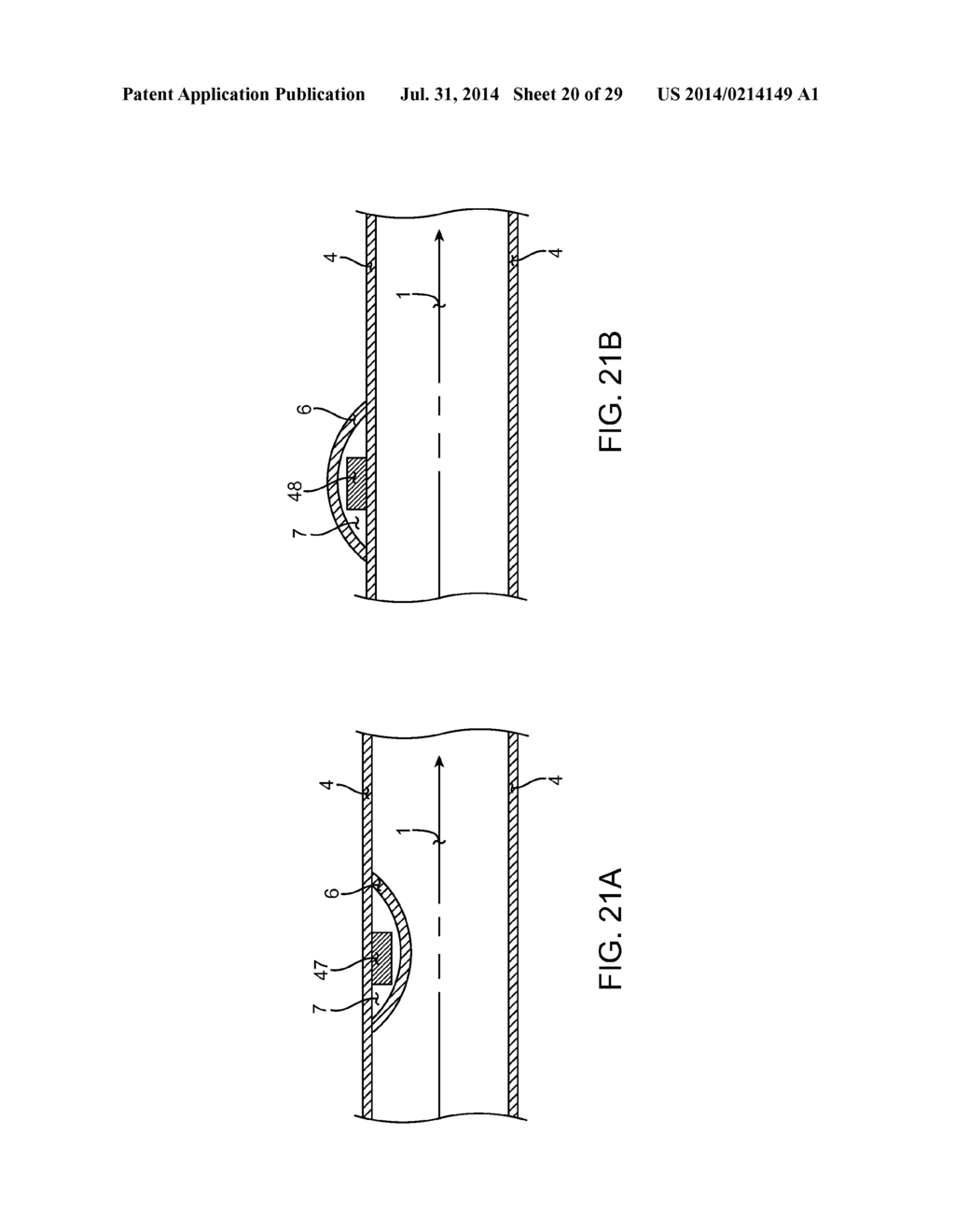 METHOD AND APPARATUS FOR MEASURING FLOW THROUGH A LUMEN - diagram, schematic, and image 21