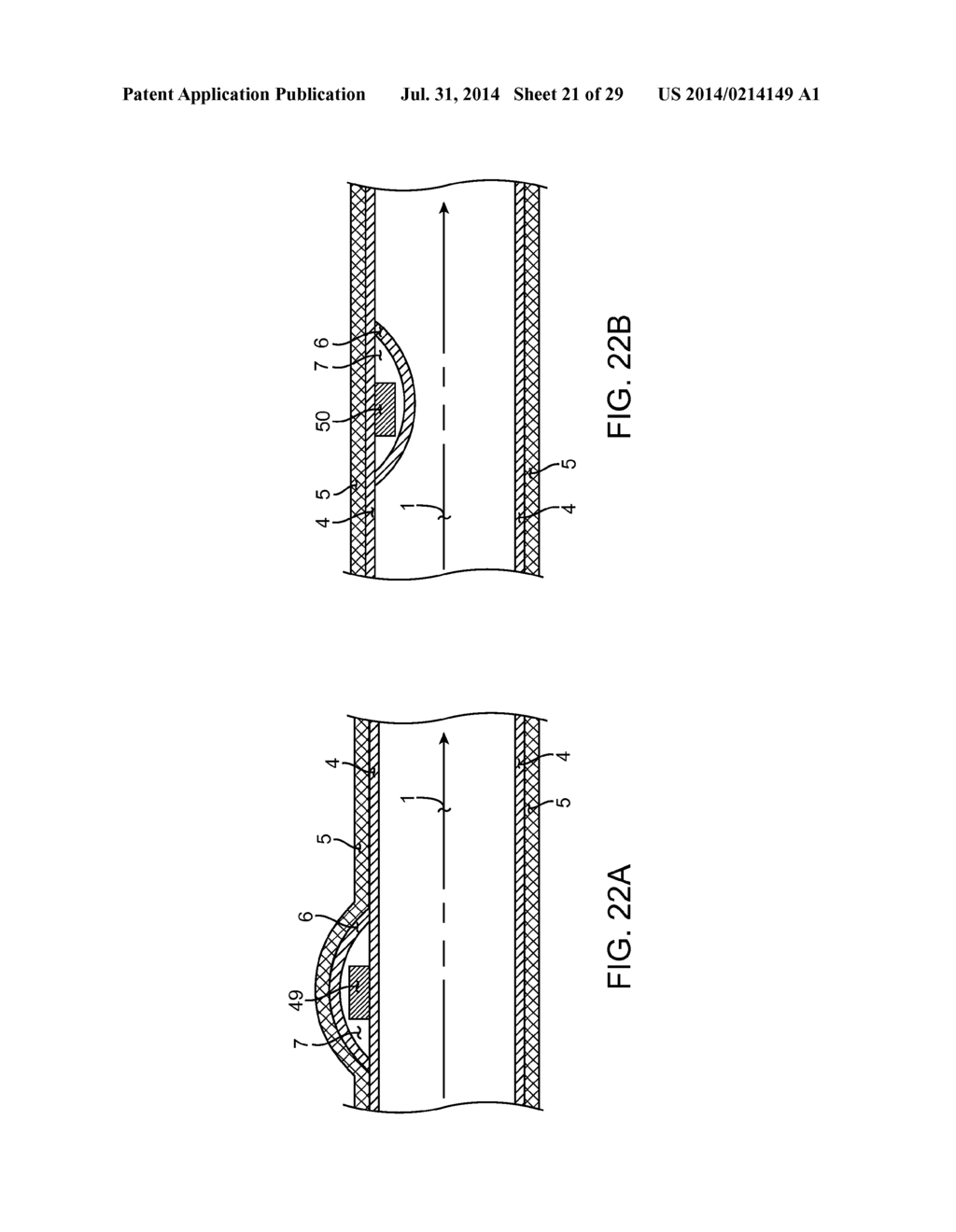 METHOD AND APPARATUS FOR MEASURING FLOW THROUGH A LUMEN - diagram, schematic, and image 22