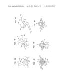 METHOD AND DEVICE FOR HEART VALVE REPAIR diagram and image