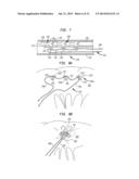 METHOD AND DEVICE FOR HEART VALVE REPAIR diagram and image