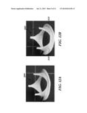 SURGICAL HEART VALVE FLEXIBLE STENT FRAME STIFFENER diagram and image