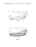 INTRA-ORAL APPLIANCE AND METHODS OF USING SAME diagram and image