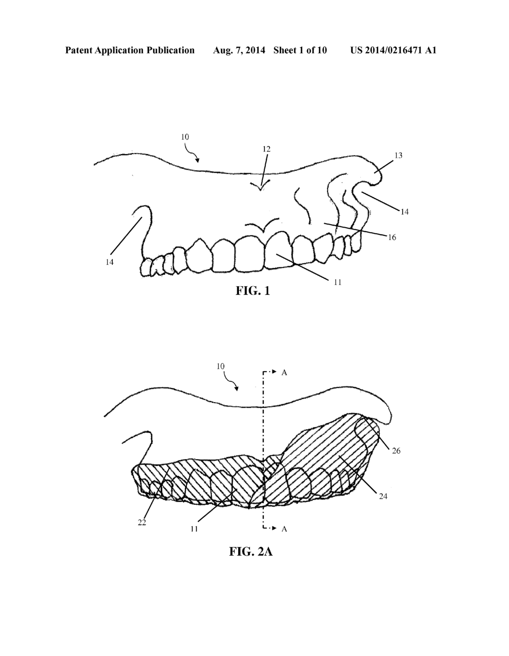 INTRA-ORAL APPLIANCE AND METHODS OF USING SAME - diagram, schematic, and image 02
