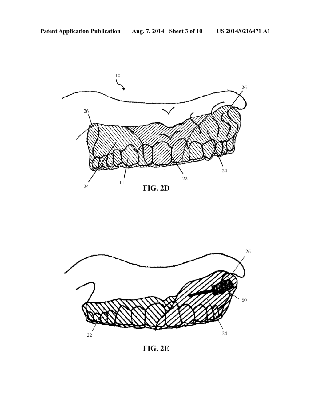 INTRA-ORAL APPLIANCE AND METHODS OF USING SAME - diagram, schematic, and image 04
