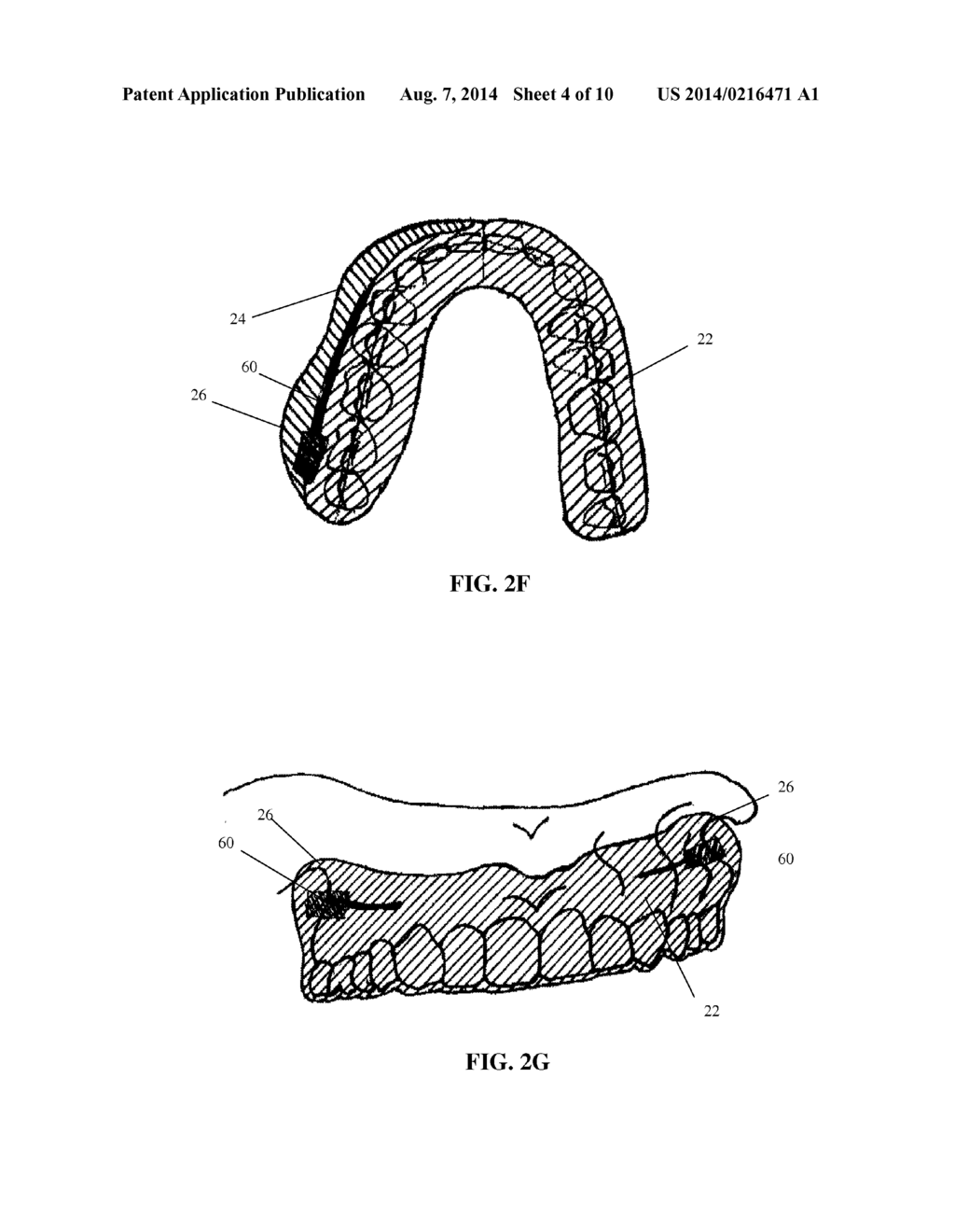 INTRA-ORAL APPLIANCE AND METHODS OF USING SAME - diagram, schematic, and image 05