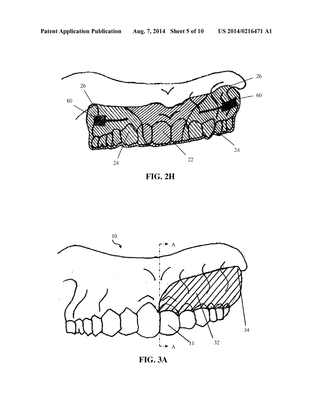 INTRA-ORAL APPLIANCE AND METHODS OF USING SAME - diagram, schematic, and image 06