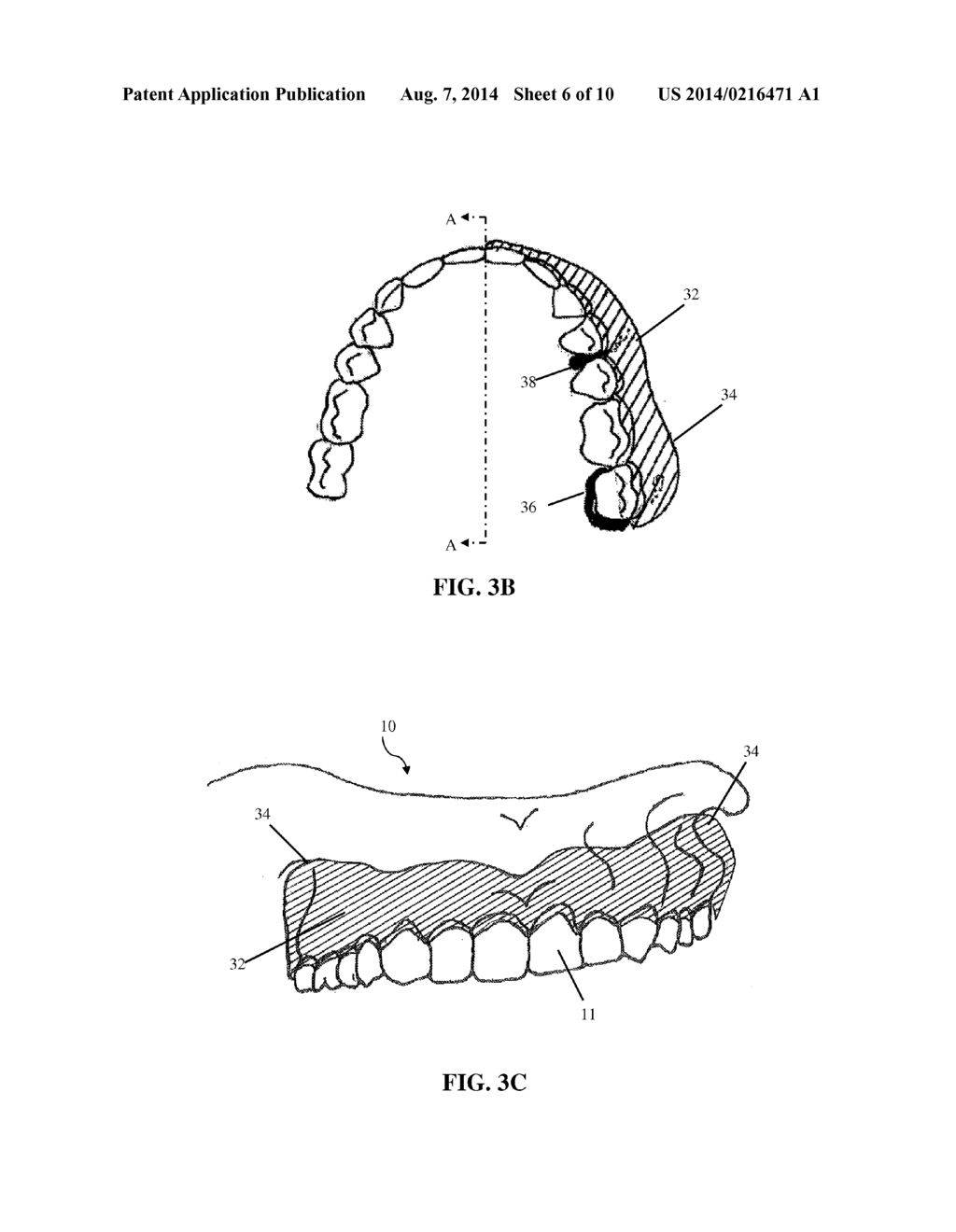 INTRA-ORAL APPLIANCE AND METHODS OF USING SAME - diagram, schematic, and image 07