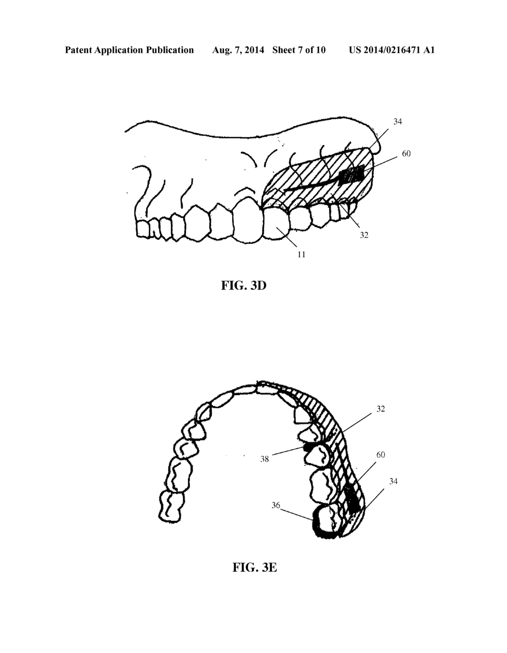 INTRA-ORAL APPLIANCE AND METHODS OF USING SAME - diagram, schematic, and image 08