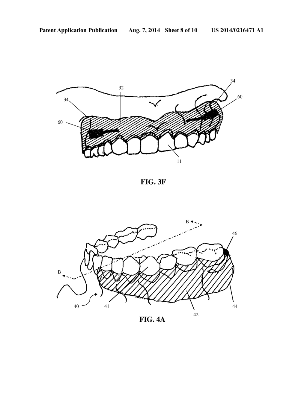 INTRA-ORAL APPLIANCE AND METHODS OF USING SAME - diagram, schematic, and image 09