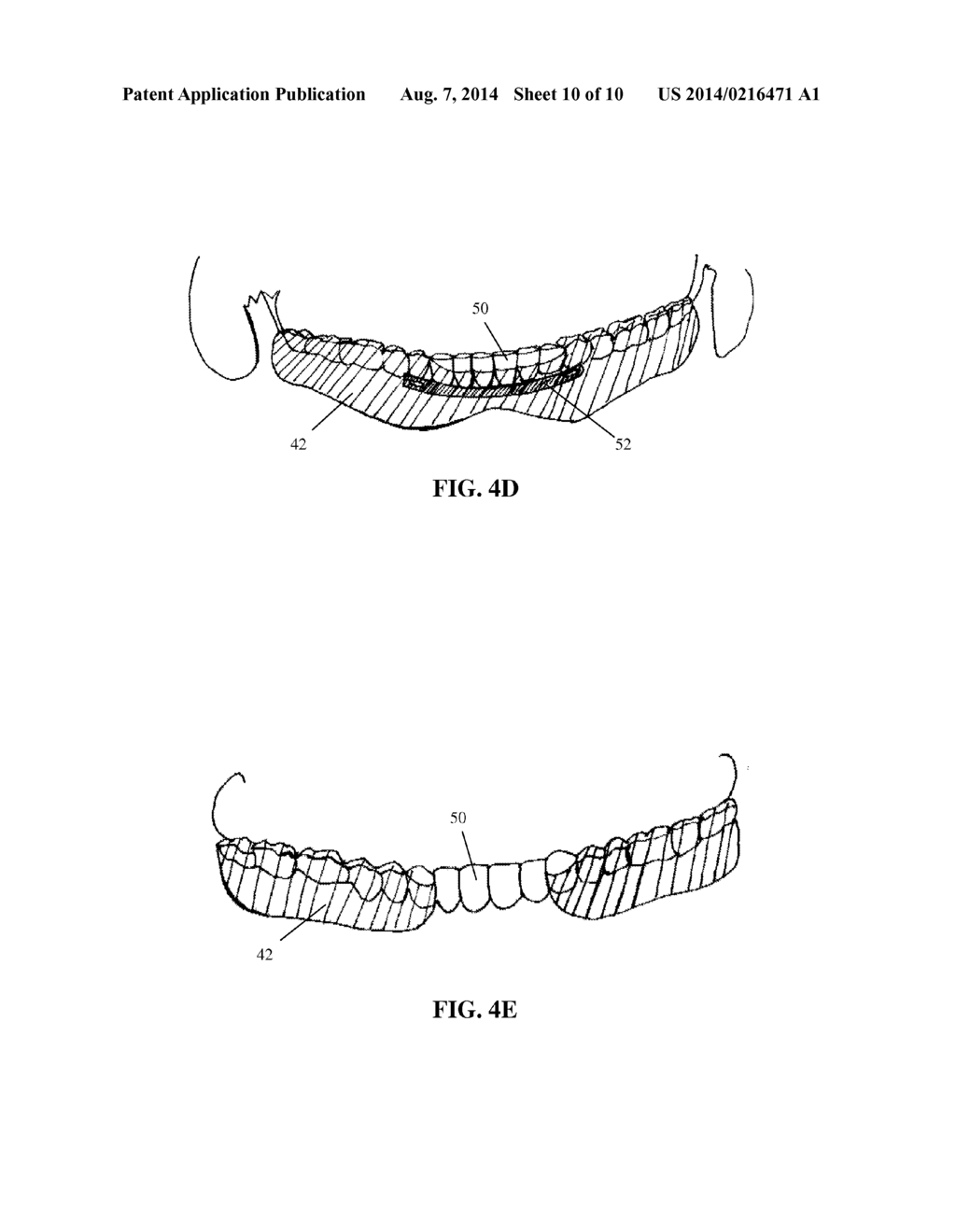 INTRA-ORAL APPLIANCE AND METHODS OF USING SAME - diagram, schematic, and image 11