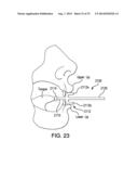 INTRAORAL TACTILE FEEDBACK METHODS, DEVICES, AND SYSTEMS FOR SPEECH AND     LANGUAGE TRAINING diagram and image