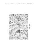 Method of Diagnosis or Prognosis of a Neoplasm Comprising Determining the     Level of Expression of a Protein in Stromal Cells Adjacent to the     Neoplasm diagram and image