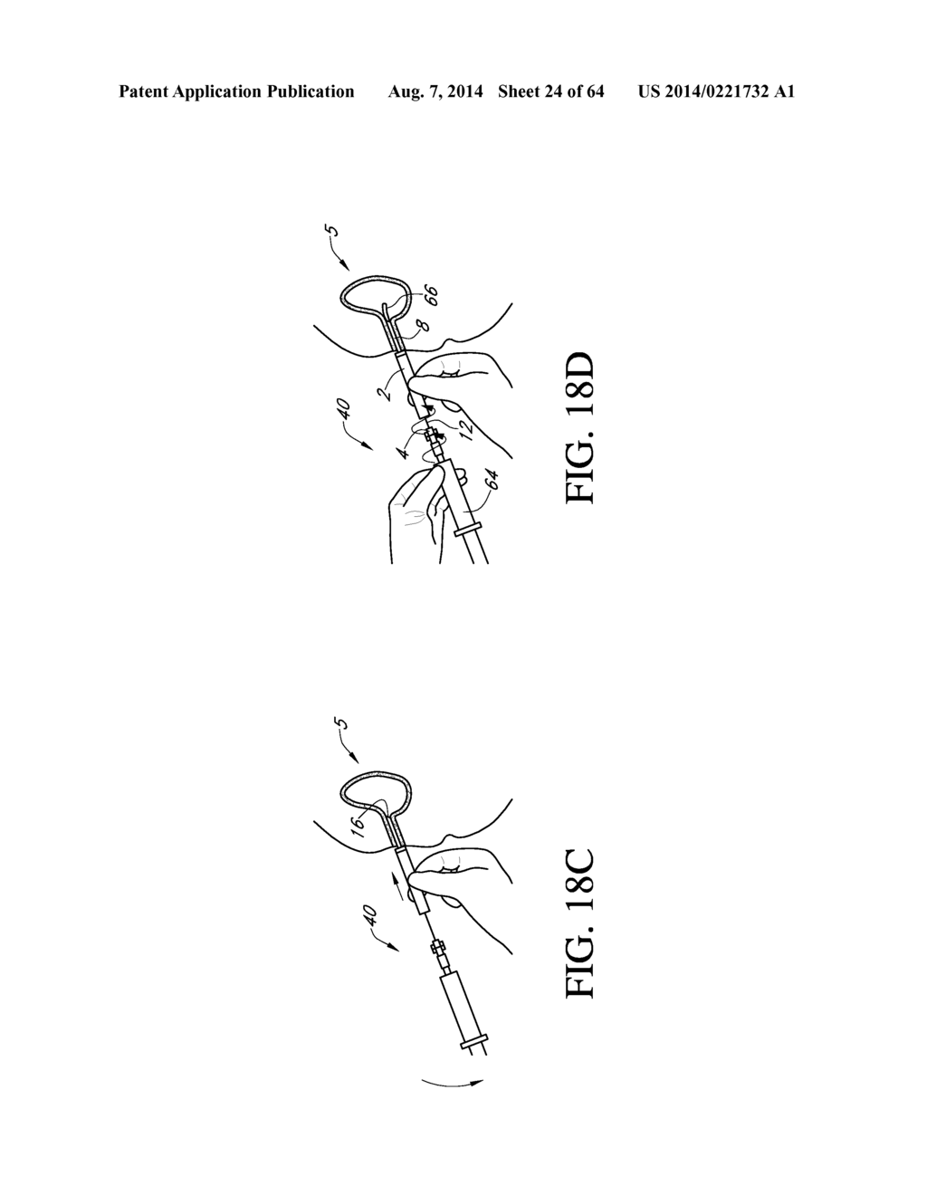 Method of removing an inflated implant - diagram, schematic, and image 25