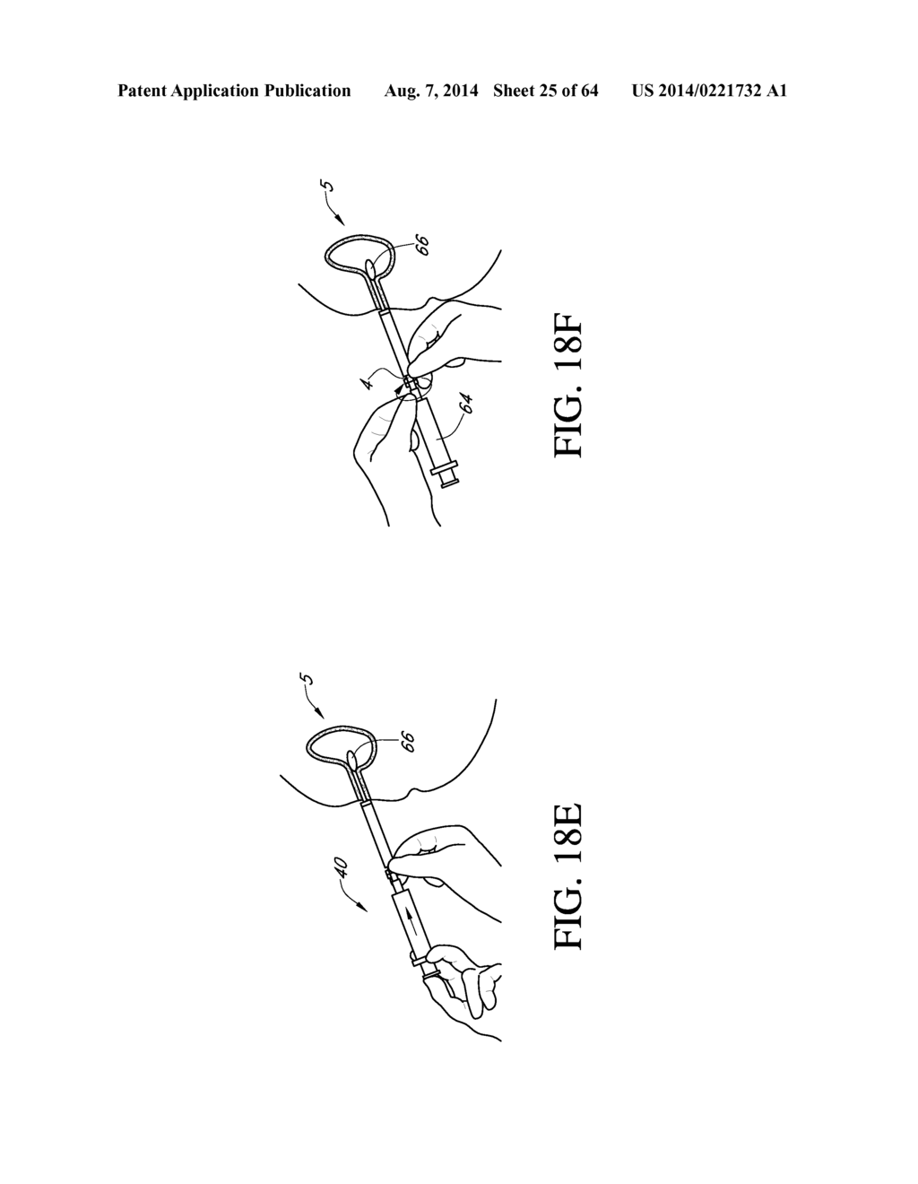 Method of removing an inflated implant - diagram, schematic, and image 26