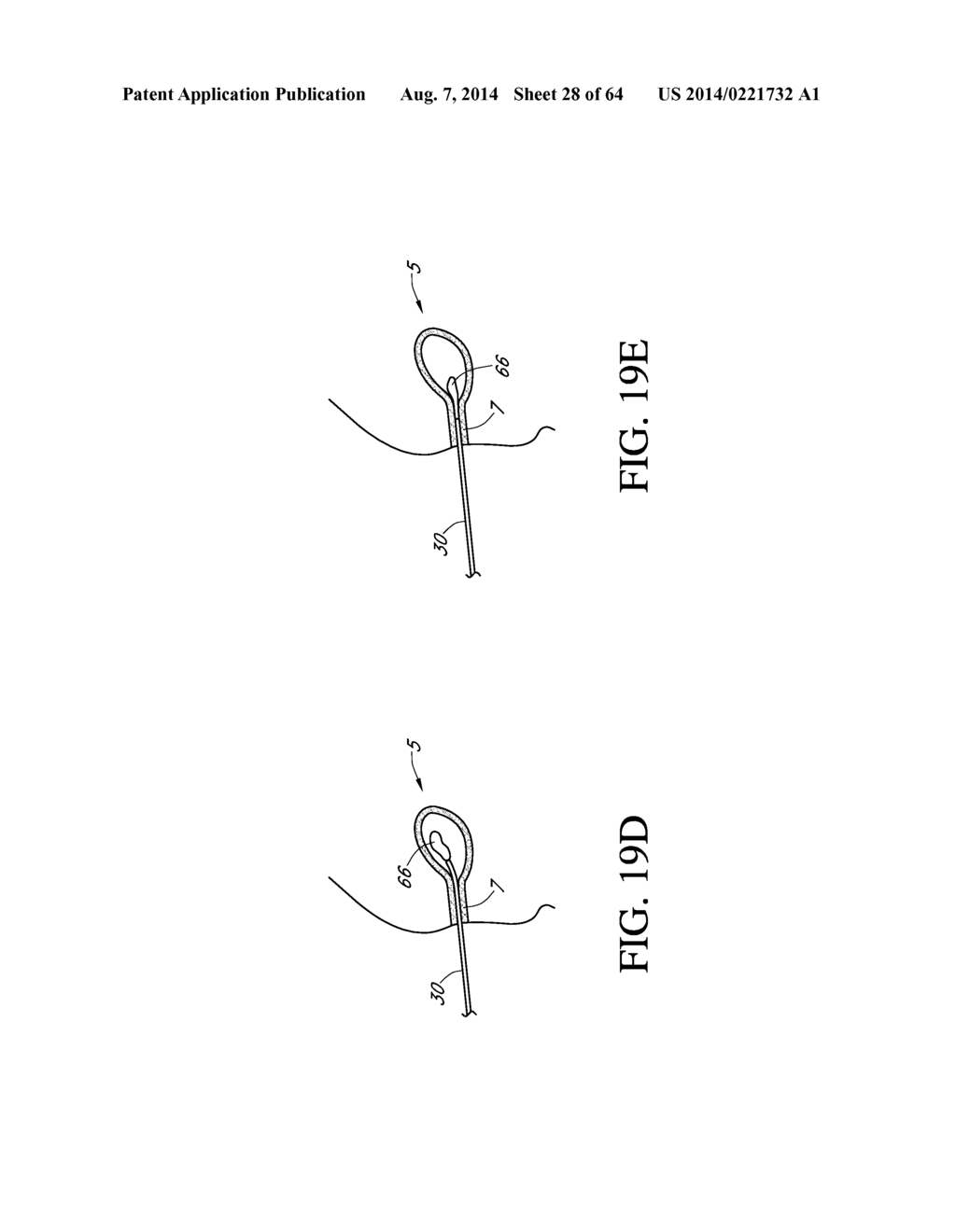 Method of removing an inflated implant - diagram, schematic, and image 29