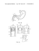 INTRAGASTRIC IMPLANT DEVICES diagram and image