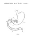 INTRAGASTRIC IMPLANT DEVICES diagram and image