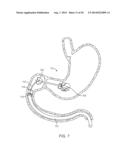 INTRAGASTRIC IMPLANT DEVICES diagram and image