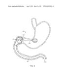 INTRAGASTRIC IMPLANT DEVICES diagram and image