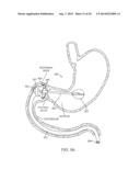 INTRAGASTRIC IMPLANT DEVICES diagram and image