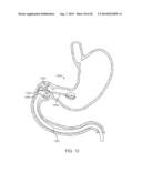 INTRAGASTRIC IMPLANT DEVICES diagram and image