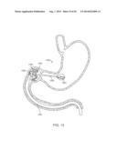 INTRAGASTRIC IMPLANT DEVICES diagram and image