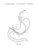 INTRAGASTRIC IMPLANT DEVICES diagram and image