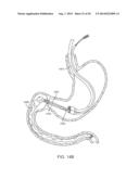 INTRAGASTRIC IMPLANT DEVICES diagram and image