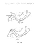 INTRAGASTRIC IMPLANT DEVICES diagram and image