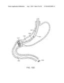 INTRAGASTRIC IMPLANT DEVICES diagram and image