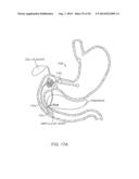 INTRAGASTRIC IMPLANT DEVICES diagram and image