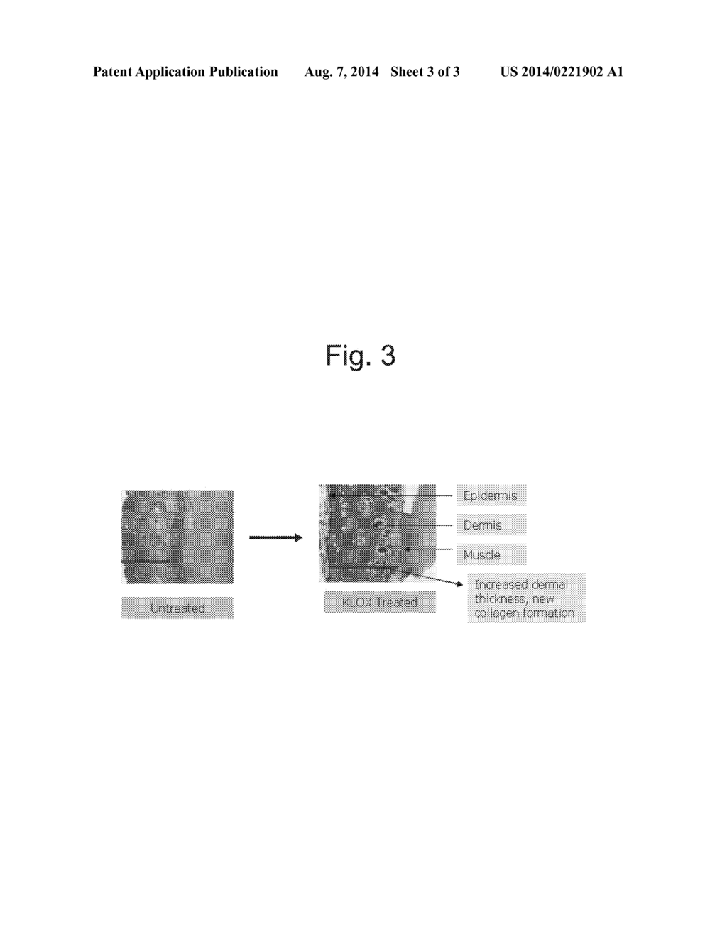 METHOD FOR ACNE TREATMENT USING AN OXIDATIVE-PHOTOACTIVATED COMPOSITION - diagram, schematic, and image 04