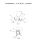 METHOD OF ARTHROPLASTY ON A KNEE JOINT AND APPARATUS FOR USE IN SAME diagram and image