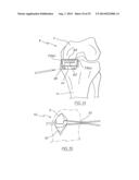 METHOD OF ARTHROPLASTY ON A KNEE JOINT AND APPARATUS FOR USE IN SAME diagram and image