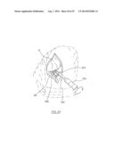 METHOD OF ARTHROPLASTY ON A KNEE JOINT AND APPARATUS FOR USE IN SAME diagram and image