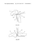 METHOD OF ARTHROPLASTY ON A KNEE JOINT AND APPARATUS FOR USE IN SAME diagram and image