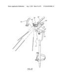 METHOD OF ARTHROPLASTY ON A KNEE JOINT AND APPARATUS FOR USE IN SAME diagram and image