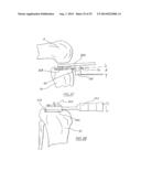 METHOD OF ARTHROPLASTY ON A KNEE JOINT AND APPARATUS FOR USE IN SAME diagram and image