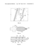 METHODS AND DEVICES FOR DIAGNOSING, MONITORING, OR TREATING MEDICAL     CONDITIONS THROUGH AN OPENING THROUGH AN AIRWAY WALL diagram and image