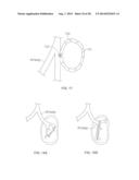 METHODS AND DEVICES FOR DIAGNOSING, MONITORING, OR TREATING MEDICAL     CONDITIONS THROUGH AN OPENING THROUGH AN AIRWAY WALL diagram and image