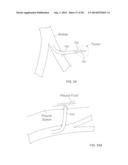 METHODS AND DEVICES FOR DIAGNOSING, MONITORING, OR TREATING MEDICAL     CONDITIONS THROUGH AN OPENING THROUGH AN AIRWAY WALL diagram and image