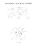 METHODS AND DEVICES FOR DIAGNOSING, MONITORING, OR TREATING MEDICAL     CONDITIONS THROUGH AN OPENING THROUGH AN AIRWAY WALL diagram and image